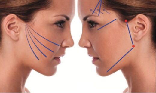 Diez tips que debes conocer sobre los hilos tensores faciales