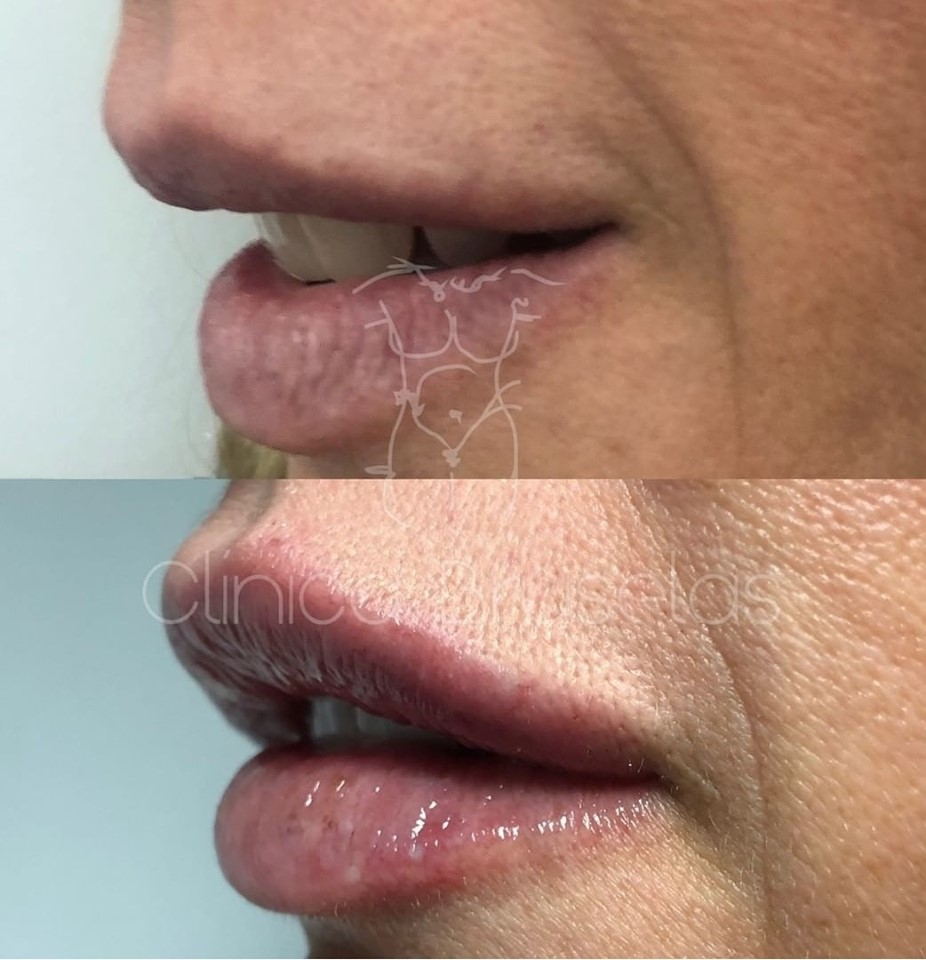 aumento de labios con ácido hialurónico