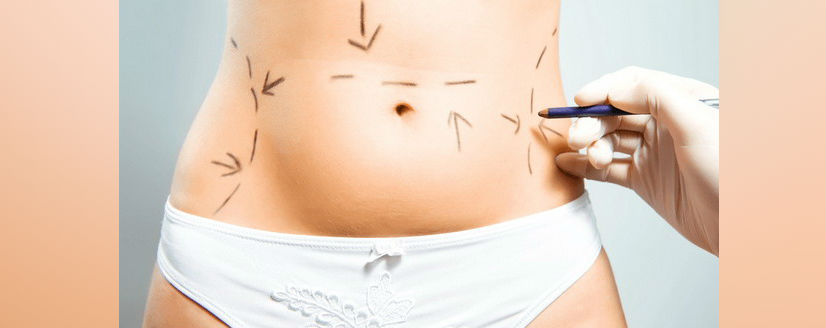 Mini abdominoplastia: elimina la piel sobrante de tu barriga