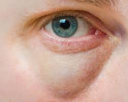Blefaroplastia inferior: Elimina bolsas de los ojos