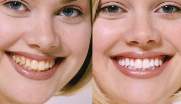 Resultados del blanqueamiento dental