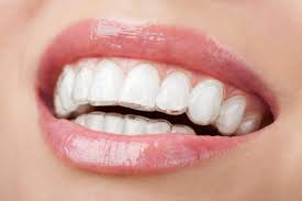 Invisalign: la ortodoncia invisible más eficaz