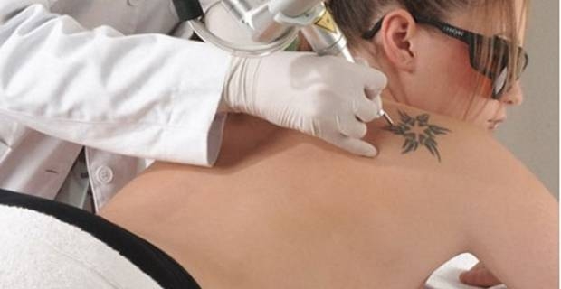 Eliminar tatuajes en Clínica Bruselas