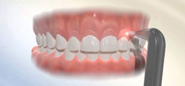 ¿Qué es una gingivectomía? Mejora tu sonrisa