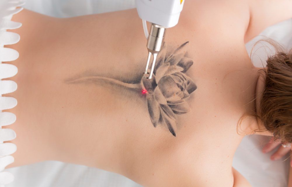 Eliminación de tatuajes con láser: borra tus tatuajes definitivamente