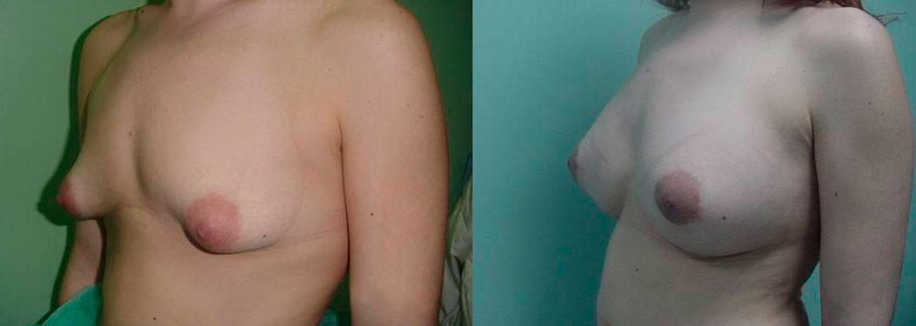 operación mamas tuberosas antes y después