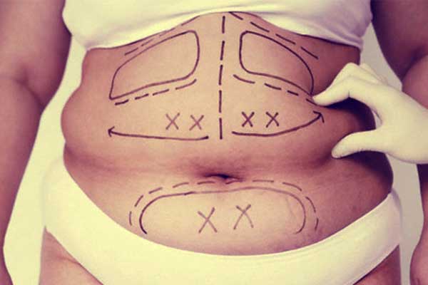 Eliminar grasa abdominal de forma definitiva: abdominoplastia normal y mini con plicatura abdominal
