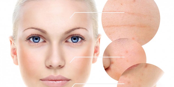 Elimina el acné con los peelings químicos