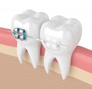 ortodoncia ¿Qué tipos de ortodoncia existen?