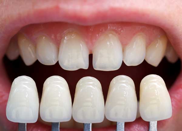 Las carillas estéticas dentales: tipos y funcionalidad