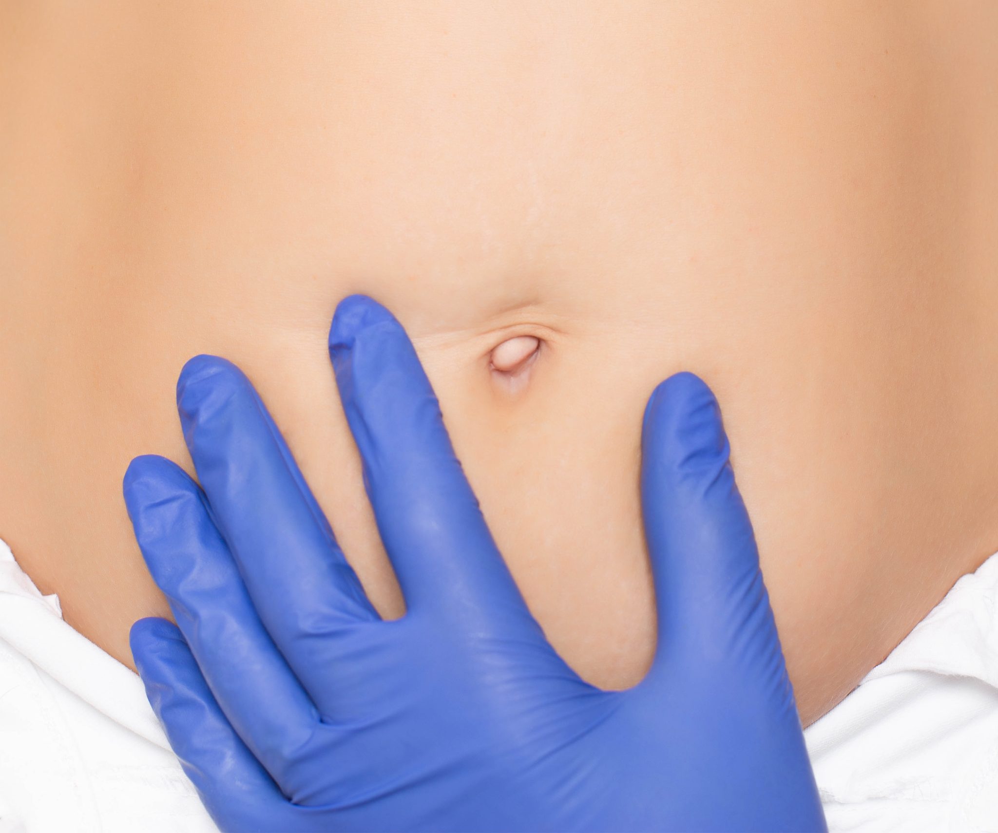 ¿Qué es la umbilicoplastia?