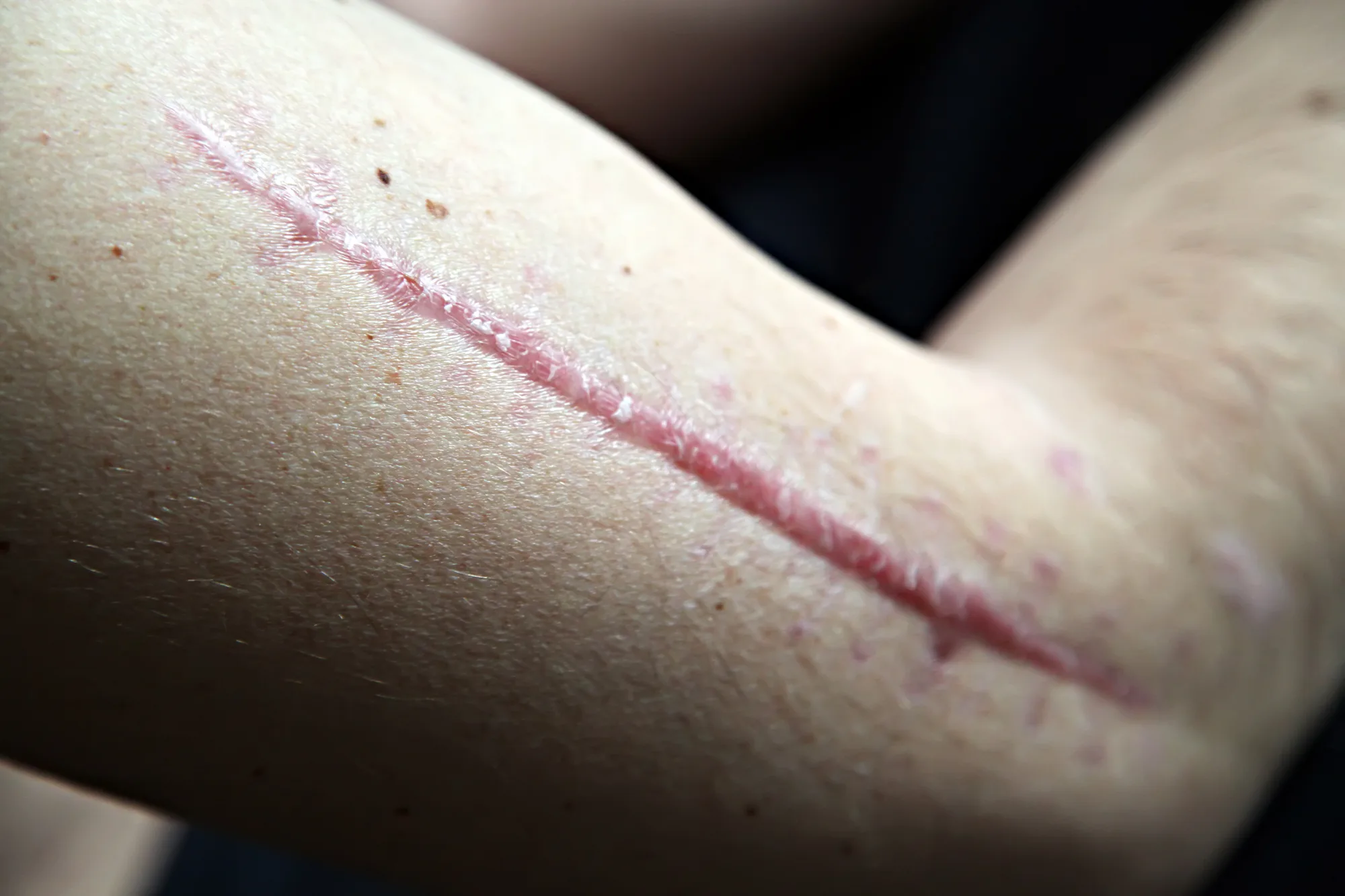 Aprende a tratar tus cicatrices para minimizarlas