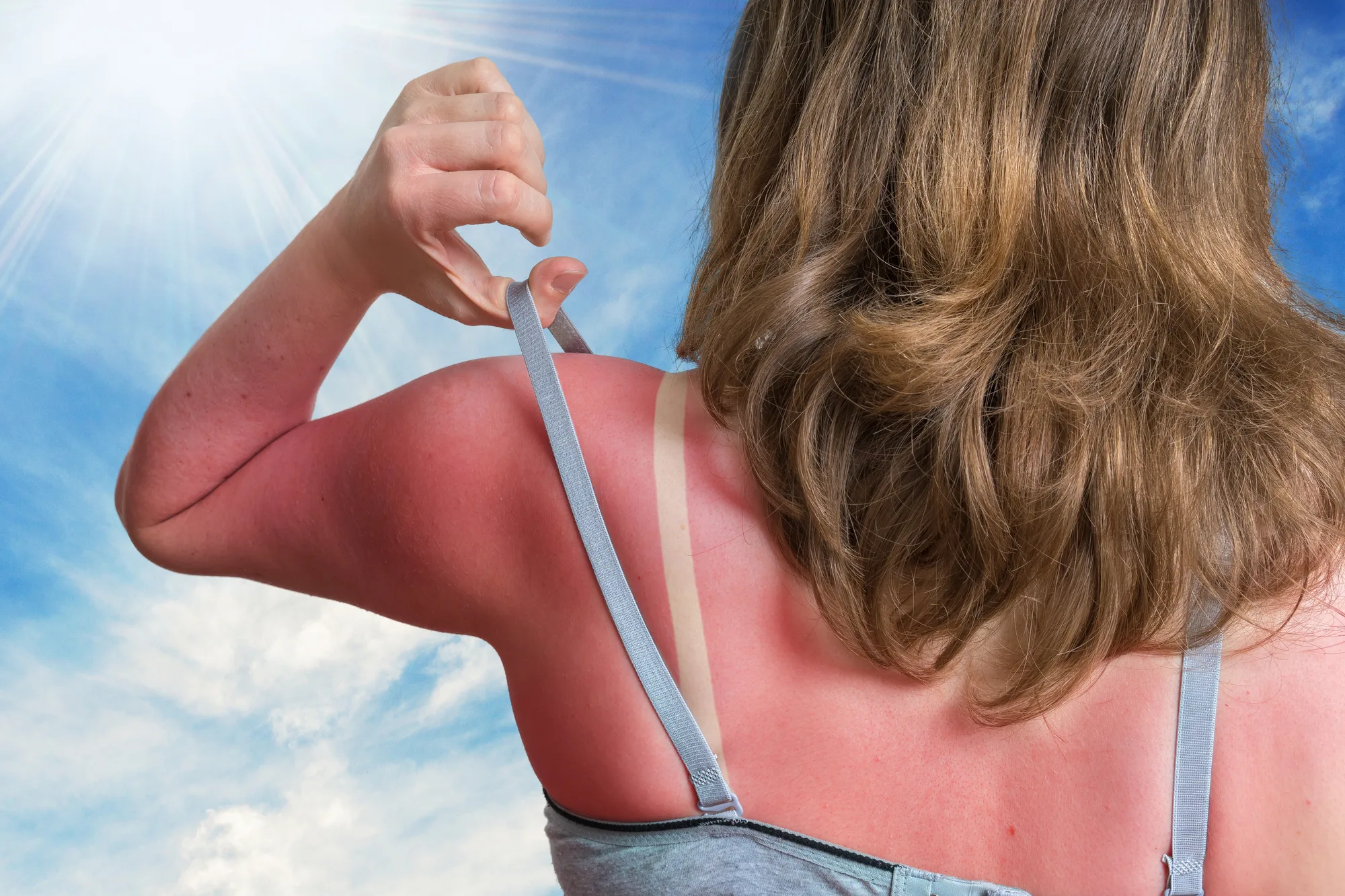 Cómo cuidar tu piel si te has quemado al sol