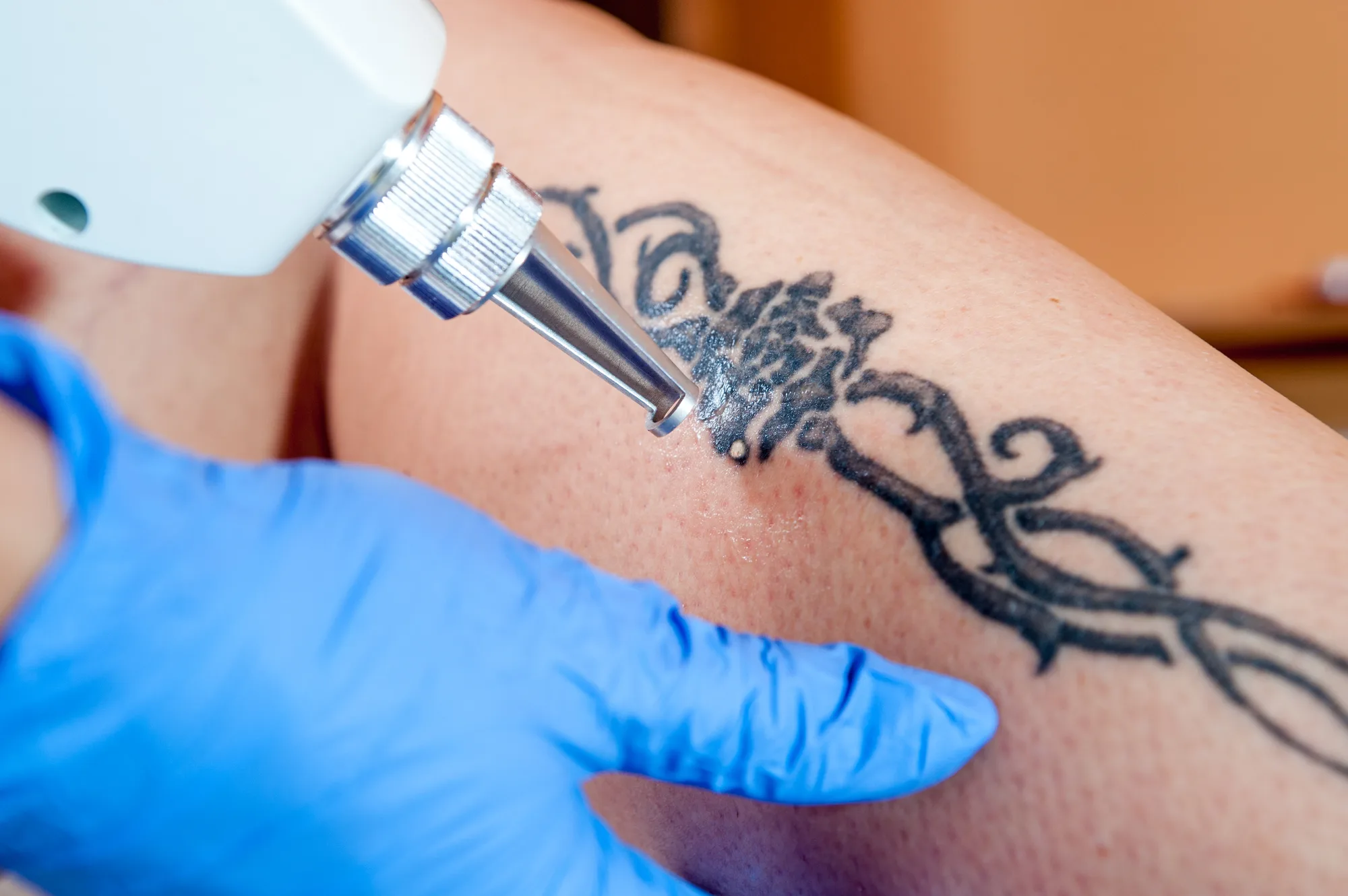 Deshazte del pasado: eliminación de tatuajes en medicina estética